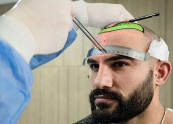 Hair Transplant Turkey Cost – Factors That Influence The Cost Of A Hair Transplant