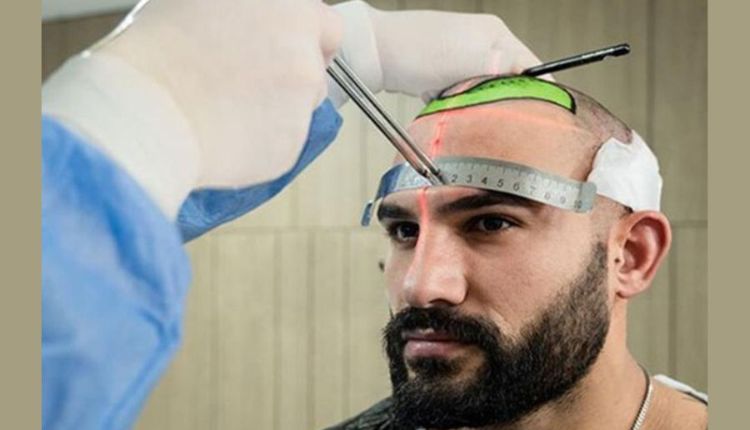 Hair Transplant Turkey Cost – Factors That Influence The Cost Of A Hair Transplant