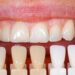 Benefits Of Porcelain Veneers In Cosmetic Dentistry