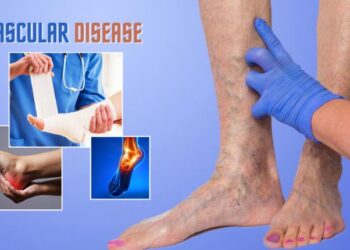 Preventing Vascular Diseases: Tips From Surgeons